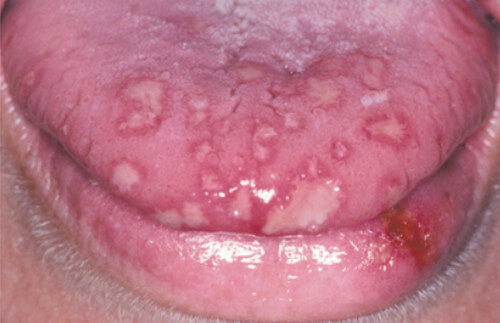 Turned white swollen taste bud Causes and